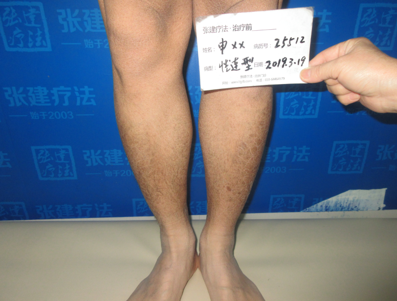 魚鱗病