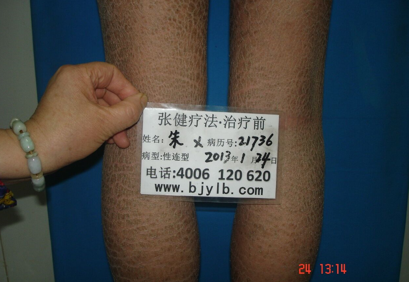 魚鱗病