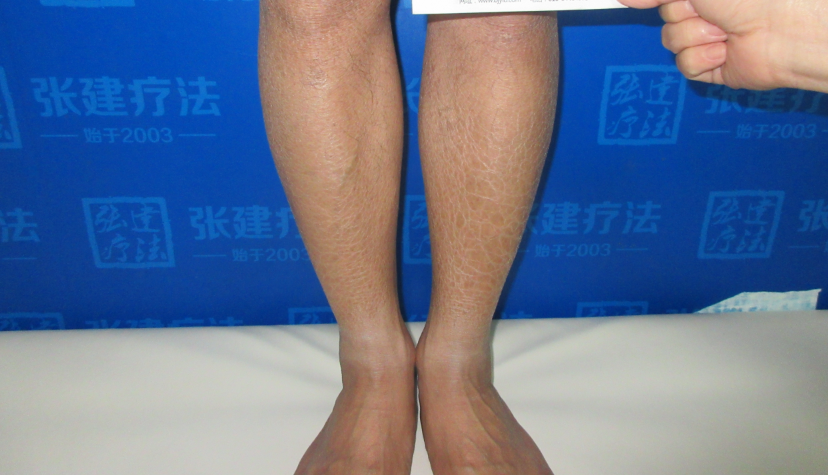 魚(yú)鱗病