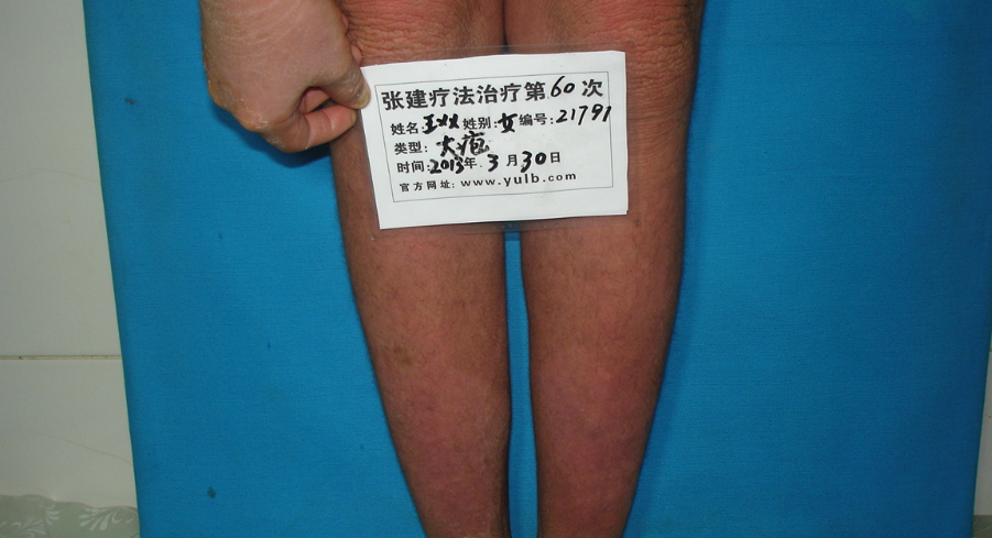 魚鱗病