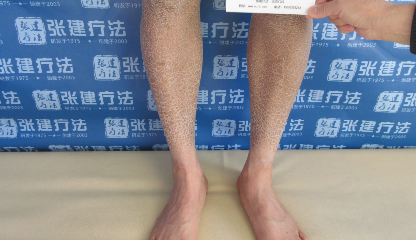 魚鱗皮膚病