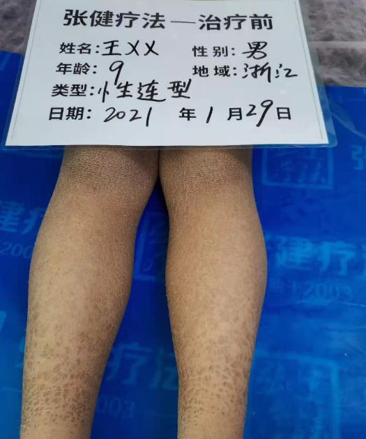 小腿魚鱗皮膚