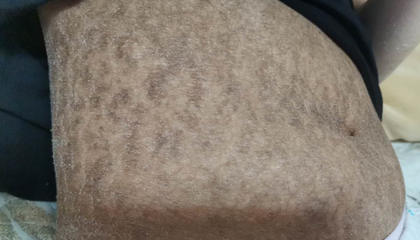 魚鱗皮膚病