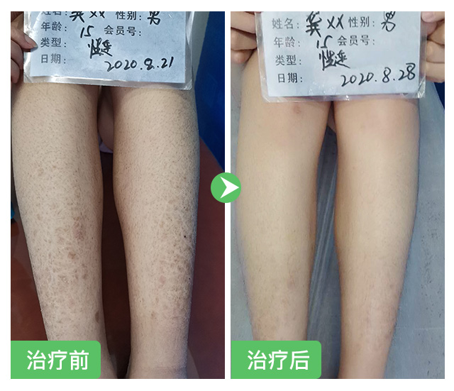 腿部魚鱗病