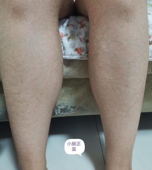魚鱗病前期